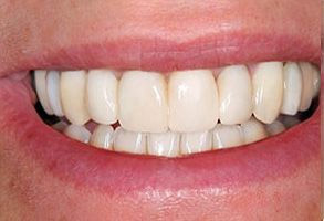 Smile gallery case 3 — after treatment