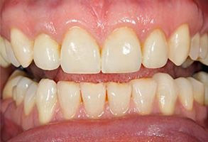 Smile gallery case 4 — after treatment