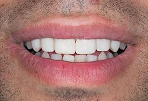 Smile gallery case 5 — after treatment