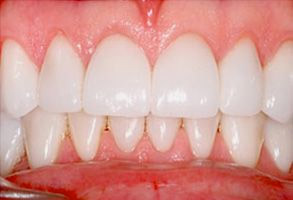 Smile gallery case 6 — after treatment